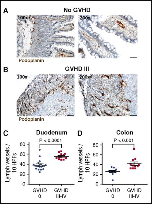 Figure 2. Lymph vessels are increased in intestinal lesions during GVHD in humans. Representative images of lymph vessels in the duodenum of patients without intestinal GVHD (A) and with grade III intestinal GVHD (B). Sections were stained with podoplanin antibody (brown), which is specifically expressed by lymphatic endothelial cells. Destructive mucosal lesions during severe GVHD are associated with lymphatic vascular proliferation. (C-D) Quantification of lymph vessels in duodenum (C) and colon (D) biopsies from patients after allo-SCT without GVHD (GVHD 0) and patients with histological aGVHD grades III-IV. Number of lymph vessels in 10 high-power fields (HPFs) was determined. Bars in ×100 magnification, 100 µm; and in ×200 magnification, 50 µm; n = 12-19 (C); n = 10-11 (D). Error bars indicate mean ± SEM; significance was tested by the Mann-Whitney U test.