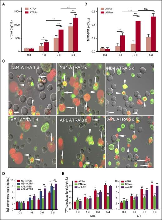 Figure 1. ATRA induces APL/NB4 cells to release procoagulant extracellular chromatin. Fresh APL cells were primed with a mix of cytokines (10 ng/mL TNF-α, 10 ng/mL IL-1β, and 10 ng/mL IL-6) for 1 hour and then were incubated with 1 μM ATRA. Levels of cf-DNA (A) and MPO-DNA complexes (B) in the supernatant were measured at the indicated time points. (C) Representative confocal microscopy images of APL/NB4 cells stained by lactadherin (green) and PI (red). Cells with expanded nuclei that lost shape and filled most of the cytoplasm were counted as ETs releasing cells (arrow). Those with condensed and fragmented nuclei were counted as apoptotic cells (arrowhead). Bars represent 10 μm. One out of 6 independent experiments is shown. (D) Promyelocytic extracellular chromatin was isolated and incubated with 20% plasma from healthy controls. TAT complexes were measured by ELISA. (E) For inhibition assays, isolated extracellular chromatin was pretreated with DNase I or anti-TF antibody before incubation with plasma. Data are from 6 independent experiments and presented as means ± SD. *P < .05, **P < .01, ***P < .001 vs day 0; #P < .05, ##P < .001 vs no inhibitor group in E.