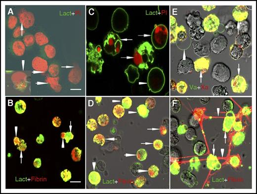 Figure 3. Different topographical distribution of fibrin on ATRA-treated NB4 cells undergoing apoptosis and ETosis. (A) On the third day of ATRA treatment, NB4 cells undergoing ETosis were stained with lactadherin (Lact; green) and PI (red). Decondensed extracellular chromatin could be seen enclosed by a thin layer of membrane (arrowhead) or spilled out of the ruptured cell (arrow). (B) Fibrin deposited on the diffuse decondensed chromatin within the bubble and also along the thin membrane around the bubble (arrowhead) and on the remaining broken cell membrane (arrow), similar to the binding sites for lactadherin. (C) On day 5, ATRA treatment led to diffuse rim staining by lactadherin on most cells undergoing early apoptosis (arrowhead). Late apoptotic cells stained with lactadherin and had condensed nuclei stained with PI (arrow). (D) Fibrin deposited at the same position as condensed chromatin inside the apoptotic cells (arrow) and also colocalized with externalized PS on the membrane that could be identified by strong staining with lactadherin (arrowhead). (E) FXa (red) and FVa (green) had patchy coherent distributions that overlapped on apoptotic NB4 cell membrane (arrow). FVa staining was observed on the thin membrane around ETs releasing cells (arrowhead). (F) A large amount of fibrin (red) strands deposited on the adjacent late apoptotic APL cells (arrow) and formed a net of fibrin (arrowhead). Representative images of 6 independent experiments are shown. Bars represent 10 μm in panels A, C, E; 20 μm in panels B, D, F.