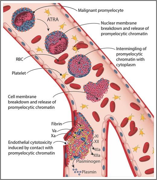 Illustration of mechanism and effects of ETosis in malignant promyelocytes following exposure to ATRA. Malignant promyelocytes on exposure to ATRA undergo nuclear and granule membrane breakdown. Subsequently, there is intermingling of chromatin and cytoplasmic contents within the cell. Following this, there is bulging, further weakening, and final breakdown of the cell membrane with release of promyelocytic chromatin, which forms a net-like structure and binds to other cells and endothelial cells. The surface of the extracellular chromatin, along with the surface membrane of the cell from which it arose, concentrates procoagulant factors and fibrin. The extracellular chromatin and cf-DNA also facilitate increased generation of plasmin and activate the intrinsic coagulation cascade. Promyelocytic extracellular chromatin also damages endothelial cells with which they come into contact, leading to a procoagulant phenotype, and provides additional surface area for clot formation and fibrin deposition. Ensuing endothelial cytotoxicity probably also leads to loss of endothelial cell integrity. RBC, red blood cell. Professional illustration by Somersault18:24.