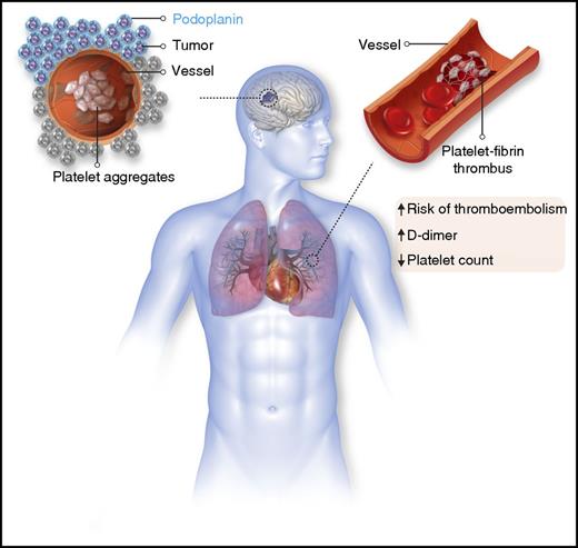 Podoplanin expression in glioma and its association with venous thromboembolism.