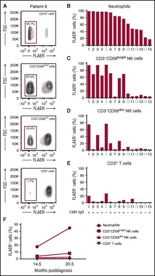 Figure 1. Comparison of GPI presence in different blood cell lineages from PNH patients. (A) Representative FLAER staining analysis on blood cell populations from patient 6, showing FLAER− (GPIneg) and FLAER+ (GPIpos) neutrophils (CD15+), NK cells (CD3−CD19−CD14−CD56+), and T cells (CD3+). Separate analyses for CD56bright and CD56dim NK cells are shown. (B) Bar graph depicts the fraction of GPIneg granulocytes for each patient. Patient samples are ordered by contribution of GPIneg cells to the neutrophil compartment starting with largest clone size. (C-E) Bar graphs depict the fraction of GPIneg cells in other lineages, (C) CD56bright NK cells, (D) CD56dim NK cells, and (E) CD3+ T cells. Patient number and CMV status (IgG+ or IgG−) are indicated. (F) Longitudinal analysis of the fraction of GPIneg cells in each lineage over time in patient 15. The x-axis indicates the time postdiagnosis and the y-axis the fraction of GPIneg cells. FSC, forward scatter.