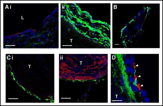 Figure 3. Podoplanin is expressed in the IVC vessel wall. Sham-operated IVC (Ai) or 48 stenosis-induced thrombi together with the IVC (Aii, B-C) were excised and stained for podoplanin (green) and PECAM-1 (Ai-ii, Ci; red) or VWF (Cii, red). Nuclei are blue in all images. (Ai-ii) Sham-operated IVC and IVC with a thrombus, respectively, photographed under identical microscope settings. Note increased podoplanin expression in the thrombosed IVC. (B) Whole thrombus after 48 hours of stenosis within the IVC. (Ci-ii) Costaining of podoplanin with PECAM-1 and VWF, respectively. Note podoplanin localization below the endothelium and absence of podoplanin in the thrombus. (D) Staining of IVC with a thrombus after 48 hours of stenosis for podoplanin (green) and platelets (CD41, red). Note platelets penetrating the vessel wall and localizing in the vicinity to podoplanin. Arrowheads indicate platelets. (A) Bar, 50 μm; (B) bar, 500 μm; (C) bar, 100 μm; n = 4-5. (D) Bar, 10 μm. Representative images of n = 3 with 10 to 15 images from each IVC. L, lumen; T, thrombus.