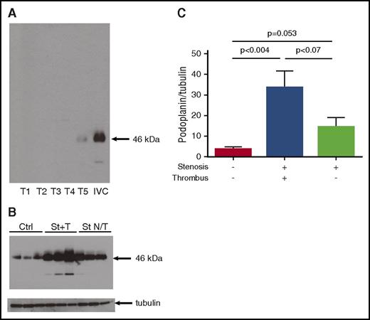 Figure 4. Expression of podoplanin in the IVC vessel wall increases with thrombosis. (A-C) Thrombi and the IVC were taken separately for western blotting. (A) Western blot of 5 thrombi vs 1 IVC after 48 hours of stenosis. Note complete absence of podoplanin in 4 of 5 thrombi and abundant podoplanin signal in the IVC. (B) Intact IVCs (lanes 1-3), IVCs after stenosis with thrombi (St+T, lanes 4-6), IVC after stenosis without thrombi (St N/T, lanes 7-9). Loading is confirmed by blotting for tubulin. (C) Densitometry of podoplanin bands normalized to tubulin; data in bar graph represent mean ± SD; n = 6 for each group. Ctrl, control.