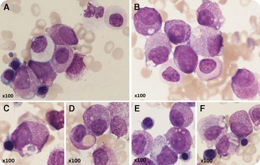 A 53-year-old man with Crohn disease and macrocytic anemia had vitamin B12 deficiency but did not improve on replacement therapy. He developed leukocytosis and his blood count showed: hemoglobin, 87 g/L; white blood cells, 15.4 × 109/L; neutrophils, 2.8 × 109/L; and platelets, 239 × 109/L. Blood film examination showed pseudo–Pelger-Huët neutrophils and abnormal promyelocytes. On bone marrow aspirate (May-Grünwald-Giemsa stain), the majority of cells were abnormal promyelocytes, confirming the diagnosis of acute promyelocytic leukemia (APL); however, morphology was atypical, with round, nonlobulated nuclei and hypergranulation of most cells but no Auer rods (panel A). There was dyserythropoiesis, granulocytic dysplasia (panel A), and nearly absent megakaryocytes. Some promyelocytes were completely agranular (panel A) but many had abnormal inclusions (panels B-F) including crystalline structures (panels E-F). Immunophenotyping showed CD34−, CD117+, CD13+, CD33+, CD56+, HLA-DR−/dim, and myeloperoxidase strong positive. G-banded analysis showed 46,XY, t(11;17)(q23;q21) with del(5)(q22q35). Fluorescence in situ hybridization studies confirmed retinoic acid receptor α (RARA) (17q21) locus (F610/16) rearrangement, and molecular testing confirmed ZBTB16-RARA RNA fusion transcripts. The patient developed a coagulopathy and was resistant to all-trans retinoic acid but achieved a morphological and complete molecular remission with daunorubicin/cytarabine. / This is a rare case of ZBTB16-RARA translocation, classified as “acute myeloid leukemia with a variant RARA translocation.” The distinctive morphological features predict a nonpromyelocytic leukemia translocation with RARA. To our knowledge, the crystalline inclusions have not been previously described.