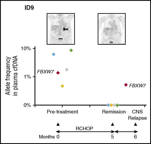 Mutational profile from cfDNA in this patient (ID9) revealed a series of mutations in the pretreatment sample. Interestingly, the FBXW7 mutation was not detected in the corresponding tumor biopsy. This mutation persisted despite clearance of other mutations from cfDNA and clinical remission. The patient relapsed in the CNS and the mutation was detected at a low level in cells from the cerebrospinal fluid. See Figure 7 in the article by Rossi et al that begins on page 1947.