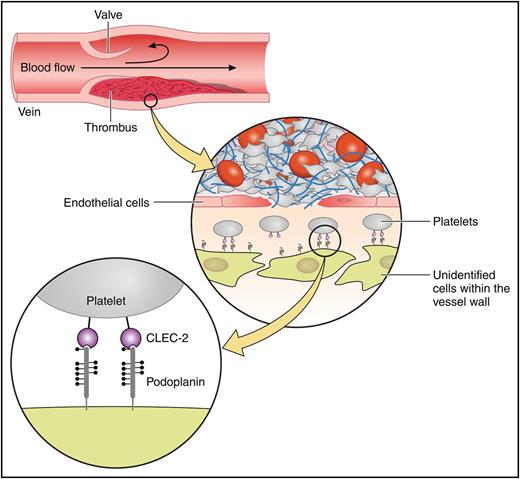 Model showing that podoplanin expression is upregulated in the vessel wall during deep vein thrombosis and stimulates platelets by binding to CLEC-2. Professional illustration by Patrick Lane, ScEYEnce Studios.