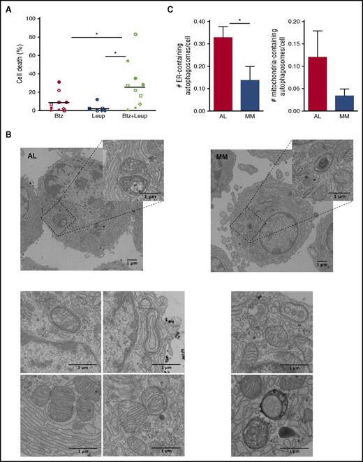 Figure 3. Abundant cytoprotective, organelle-homeostatic autophagy in primary amyloidogenic PCs. Assessment of autophagy and its role in primary AL PCs. (A) Proportion of cell death upon 24 hours of treatment with the distal autophagic inhibitor, leupeptin (Leup; 10 µM) and Btz (2 nM), alone or in combination, as assessed by cytofluorimetric analysis upon labeling with propidium iodide and fluorescent-conjugated antibody anti-syndecan 1 and annexin V. Each dot represents 1 of 10 AL patients. (B) EM analysis of autophagosomes in primary AL (left) and MM (right) PCs (representative images). (C) EM quantification of ER-phagy (left) and mitophagy (right) in AL and MM PCs. The histograms show the average numbers ± standard error of ER- and mitochondria-containing autophagosomes per PC in each AL and MM patient (>20 PCs per AL and MM patient; 5 patients per group). *P < .05 (Student t test).