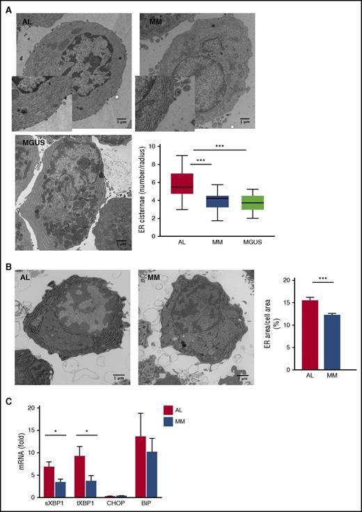 Figure 4. Perturbed ER homeostasis in primary amyloidogenic PCs. Assessment of ER abundance and homeostasis in primary PCs by EM (5-35 PCs per patient; 7 AL, 5 MM, and 3 MGUS patients per group) and G6Pase EM cytochemistry (>20 PCs per patient; 3 AL, 3 MM patients per group). (A) Representative EM images of BM PCs in AL, MM, and MGUS patients (insets: magnification ×1840), and quantification of ER size by stereography counting the number of ER cisternae intersecting the main cellular axes. Box plots show median, maximum, and minimum, and first and third quartile values. (B) Representative G6Pase EM cytochemistry images of BM PCs in AL and MM patients, and automated quantification of G6Pase+ area (ER size), relative to total cell area (mean ± standard error). (C) Quantitative reverse transcription PCR analysis of transcripts encoding ER-stress responsive proteins (8 AL and 7 MM primary samples). Histograms show mean values ± standard error. ***P < .0001; *P < .05 (Student t test). BiP, immunoglobulin heavy chain binding protein; CHOP, CCAAT/enhancer-binding protein homologous protein; sXBP1, spliced X-box binding protein 1; tXBP1, total X-box binding protein 1.