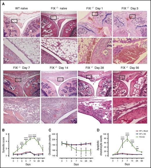 Figure 1. Evolution of IA pathology during 8-week time course of joint wound healing of FIX−/− mouse following hemarthrosis. (A) Representative histopathology. Images were captured on a Nikon Microphor SA microscope equipped with 10/0.30, 20/0.50, and 40/0.70 numeric aperture objective lenses. Photographs were taken with a DMX-1200 color camera using the Act-1 software (entire system from Nikon Instruments, Melville, NY). Representative images of joint histology for each condition/time point are shown at original magnification ×40 (top) and ×200 (bottom). WT naïve and FIX−/− naïve display normal histology of the uninjured mouse knee joint, with distal femur oriented on the left and proximal tibia on the right, with meniscus and synovial/subsynovial histology seen in the center, displaying normal 3-4 cell layer synovium overlying subsynovial fat with rare subsynovial blood vessels. Following hemarthrosis FIX−/− mouse histology is remarkable on day 1 only for frank blood within the joint space and in the subsynovial space. Day 3 thickening of the synovial lining is evident. By day 7, the subsynovial space is replaced by a dense collection of inflammatory infiltrate and proliferative synoviocytes, which is punctuated by day 14 with frequent neovascular structures. Synovial hyperplasia resolves in some (although not all) FIX−/− mice by day 56 following the single gross hemarthrosis; however, abnormal vascular changes persist. (B) Time course of synovial pathology. Joint capsule puncture was induced at day 0 in C57Bl/6J FIX−/− mice, in 2 separate cohorts of C57Bl/6J hemostatically normal (WT) mice. NS was injected into the joint at the time of needle puncture for one-half of the WT mice (WT + NS, ▪) and for all of the FIX−/− mice (FIX−/−, ●). The other half of the WT mice received autologous citrated whole blood injected into the joint at the time of needle puncture (WT + Blood, ▲). Separate groups of mice were euthanized for histopathologic examination of hematoxylin and eosin–stained joints at each time point during the 8-week time course. Hemophilic synovitis was graded 0 to 10 points for increasing pathology, according to the Valentino mouse hemophilic synovitis scale,25 which awards 0 to 10 points for increasing evidence of synovial overgrowth, neovascularity, and articular bleeding. Areas of greatest synovial thickening and vascularity were identified, and the average synovitis score from 3 nonoverlapping high-magnification fields was recorded. Points that are significantly different from “WT + Blood” are indicated by “*.” Points that are significantly different from “WT + NS” are indicated by “#.” Markers of significance are used as follows: *P < .05, ***P < .001, ****P < .0001, #P < .05, ##P < .01, ####P < .0001. (C) Time course of total chondrocyte number. Total chondrocytes were counted in a blinded manner in 10 randomly selected hematoxylin and eosin–stained fields of femoral and tibial cartilage using a 20× objective lens. The mean and standard deviation for the entire cohort of animals at each time point is plotted. Points that are significantly different from “WT + Blood” are indicated by “*.” Points that are significantly different from “WT + NS” are indicated by “#.” Markers of significance are used as follows: *P < .05, **P < .01, #P < .05. (D) Time course of apoptotic chondrocytes. Apoptosis was assessed by terminal deoxynucleotidyl transferase-mediated dUTP nick-end labeling (TUNEL) using an In Situ Cell Death Detection Kit (Roche Diagnostics Corporation, Indianapolis, IN). TUNEL-positive cells were counted in a blinded manner in 10 randomly selected fields using a 20× objective lens. Points that are significantly different from “WT + Blood” are indicated by “*.” Points that are significantly different from “WT + NS” are indicated by “#.” Markers of significance are used as follows: **P < .01, ****P < .0001, ###P < .001, ####P < .0001.
