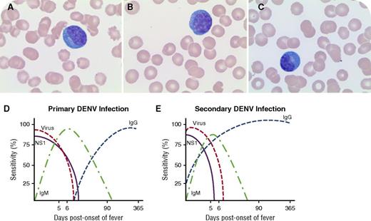 A 36-year-old man presented with fever, myalgia, and fatigue after a trip to India. Laboratory studies revealed a white blood cell count of 2.8 × 109/L, hematocrit of 40.1%, platelet count of 18 × 109/L, abnormal liver function tests, elevated fibrin degradation products, and elevated D-dimer levels. Serologic tests for Epstein-Barr virus and cytomegalovirus were consistent with past infection and were negative for chikungunya virus, HIV, and hepatitis B virus. A peripheral blood smear was negative for parasites; however, increased atypical plasmacytoid lymphocytes (28%) were seen (panels A-C; original magnification ×100, Wright-Giemsa stain). A serologic test demonstrated increased dengue virus immunoglobulin G (IgG) titers at 15.08 IV (normal, ≤1.64 IV) while dengue virus IgM titer was normal at 1.41 IV (normal, ≤1.64 IV), consistent with secondary infection. Supportive treatment resulted in full resolution of symptoms, platelet recovery to 97 × 109/L, and disappearance of plasmacytoid lymphocytes. / Atypical plasmacytoid lymphocytes can be seen in dengue virus infection in addition to other conditions such as serum sickness, hyperimmunization, and rubella. Although typically high IgM and IgG levels are detected in primary infection (panel D), IgM can be significantly lower or undetectable in secondary infection (panel E) (panels D-E are adapted from https://www.cdc.gov/dengue/clinicallab/laboratory.html). Ideally, further confirmation is recommended using polymerase chain reaction, viral culture, or IgM/IgG seroconversion in paired sera. The presence of atypical plasmacytoid lymphocytes in a proper clinical context should alert the physician toward a possible diagnosis of dengue virus infection and necessitates further testing.