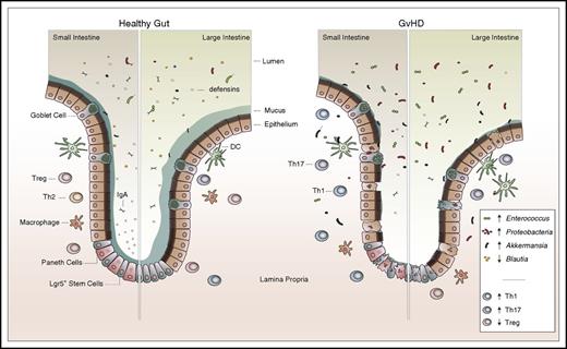Figure 1. Intestinal damage and dysbiosis linked to GVHD. Upon HCT, multiple factors such as conditioning toxicity, antibiotic treatment, and immune activation mediate GVHD. GVHD progression associates with injury to stem cell compartments along with Paneth cells (small intestine) and goblet cells. This leads to increased intestinal permeability, inflammation, and reduction of the mucus layer and antimicrobial products (eg, defensins). Antibiotic treatment and a limited amount of nutrients in the gut also promote gut dysbiosis, furthering gastrointestinal damage and disease. DC, dendritic cell; IgA, immunoglobulin A.