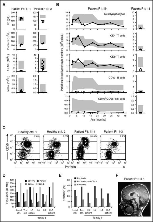 Figure 1. Cellular deficiencies and neurological manifestations in family 1. (A) Peripheral blood hemoglobin (Hb), platelet, neutrophil (Neutro.), and monocyte (Mono.) counts as well as (B) lymphocyte subset counts in F1:III-1 and F1:I-3, who subsequently were diagnosed with childhood and adult MDS, respectively. Each patient was repeatedly assessed, with individual measurements denoted by circles. Gray boxes depict age-related reference values. (C) Plots show perforin versus CD56 expression among gated CD3− lymphocytes, as assessed by flow cytometry. (D) Bar graph depicts the relative median fluorescence intensity (R-MFI) of CD107a, perforin, granzyme A (Gzm A), and granzyme B (Gzm B), as indicated, in gated CD3−CD56dim NK cells. (E) Bar graph depicts the frequency of exocytosing CD3−CD56dim NK cells, as evaluated by induction of surface CD107a expression (ΔCD107a), by target cells, as indicated. (F) Sagittal magnetic resonance image of F1:III-1 revealing bilateral white substance changes and cerebellar degeneration. Ctrl, control; Trp, transport control.