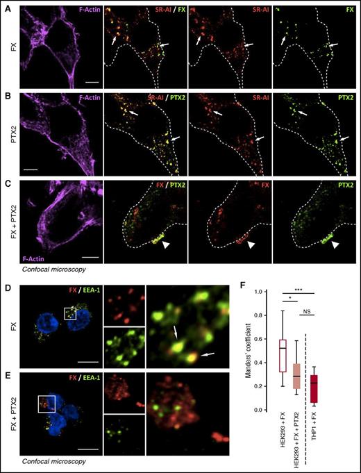 Figure 3. PTX2 reduces FX internalization in SR-AI–expressing HEK293 cells. SR-AI–expressing HEK293 cells were incubated with 150 nM of FX (A), 500 nM of PTX2 (B), or both (C) for 1 hour at 37°C and then washed and fixed. Representative confocal microscopy images of FX or PTX2 immunostaining along with SR-AI (A-B) or coimmunostaining of FX and PTX2 (C) are depicted. FX (red) and EEA-1 (green) were immunostained in SR-AI–expressing HEK293 cells incubated with either FX (D) or FX + PTX2 (E), and images were acquired in confocal microscopy. FX colocalization with EEA-1 was quantified by calculating the tMC for FX using JACoP plugin in Fiji software (F). Results are expressed in a whisker plot where boxes represent the median and 25th to 75th percentile, and bars represent the minimum and maximum of 10 to 11 cells in 3 different experiments. *P < .05; ***P < .001 in a Mann-Whitney nonparametric unpaired statistical test. N.S., not significant. In representative confocal images, dotted lines define cell boundaries based on phalloïdin staining, arrows indicate internalized FX or PTX2 colocalized with SR-AI (A-B) or area of colocalization between FX and SR-AI (D), and arrowheads indicate colocalization between FX and PTX2 (C). Objective 63×, z-depth 1 µm; bars represent 10 µm.