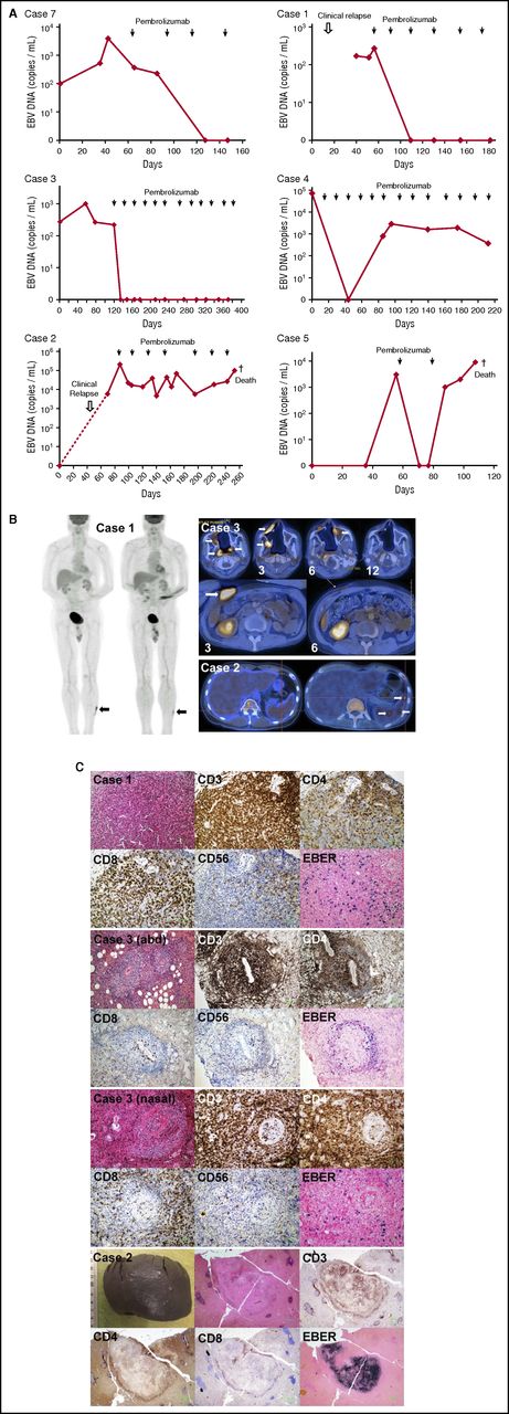 Figure 1. Treatment of 7 patients with relapsed/refractory NK/T-cell lymphomas treated with pembrolizumab. (A) Changes in circulating EBV DNA with pembrolizumab treatment. Case 7 relapsed after allogeneic HSCT. Undetectable EBV DNA correlated with CR on PET/CT scan and histologic examination of marrow after 3 cycles and onward. Case 1 had biopsy-proven cutaneous relapse 1.5 years after SMILE-induced CR. His skin lesions responded after the first cycle, paralleled by a decrease of EBV DNA to undetectable. After 4 cycles, with EBV DNA remaining undetectable, a biopsy of the index skin lesion still showed minimal EBER+ cells. He continued to remain asymptomatic with undetectable plasma EBV DNA after 2 more cycles. Case 3 had relapsed nasal lymphoma with marrow involvement and HPS. After the first cycle, symptoms and laboratory abnormalities resolved, with a concomitant fall of EBV DNA to undetectable. Despite repeated appearance of apparently new lesions on PET/CT in the nasal area and abdomen (abd) after 3, 6, and 9 cycles, his EBV DNA remained undetectable. He finally achieved metabolic CR on PET/CT after 12 cycles, demonstrating the prognostic importance of undetectable EBV DNA on disease remission. Case 4 presented with liver and marrow involvement, associated with HPS. After the first cycle, there was rapid improvement and resolution of HPS, paralleled by a fall of EBV DNA to undetectable after 4 cycles. After 6 cycles, PET/CT and marrow examination showed CR. EBV DNA then rose back to 102 to 103 copies/mL. He has to date received 13 cycles, remaining in clinical and radiologic remission. Case 2 relapsed with involvement of liver, spleen, and marrow and HPS 7 years after allogeneic HSCT. Symptoms and laboratory abnormalities resolved with initiation of treatment. After 3 cycles, EBER+ cells were cleared from the bone marrow. However, plasma EBV DNA remained detectable, heralding reappearance of EBER+ cells in the marrow when assessed after 3 more cycles. He then developed a chest infection and died as a result of sepsis. Case 5 presented with HPS on relapse. PET/CT showed hepatic involvement. After 1 cycle, symptoms and HPS resolved, with EBV DNA falling to undetectable. However, after the second cycle, there was an increase in EBV DNA. He then died as a result of sepsis consequent on gastrointestinal bleeding caused by gastric ulcers. (B) PET/CT results. Case 1: pretreatment scan showed a hypermetabolic lesion in left leg (left panel; arrow). Posttreatment scan showed that the lesion (arrow) was metabolically less active than the liver, hence qualifying for a Deauville score of 3. Case 3: evolution of nasal lesions in 4 consecutive scans (upper panel). Note complete destruction of all midline nasal structures. Leftmost was the PET/CT before pembrolizumab treatment, showing several hypermetabolic foci (arrows). After 3 cycles of pembrolizumab treatment, all pretreatment index lesions disappeared, but apparently new lesions appeared (arrows). After the sixth cycle of treatment, apparently new lesions developing after the third cycle had disappeared, but new lesions appeared again (arrow). After the 12th cycle, all hypermetabolic lesions had disappeared, and metabolic CR was achieved. Apparently new abdominal wall lesion, not present before treatment, appeared after 3 cycles of pembrolizumab therapy (lower panel; arrow). After the sixth cycle of pembrolizumab, the lesion completely disappeared. Case 2: pretreatment scan showed diffuse liver and spleen uptake. Posttreatment scan showed that uptake was confined to 3 small splenic foci (arrows). (C) Histopathologic evaluation of index lesions after pembrolizumab treatment. Histologic and immunophenotypic evaluations were performed by standard protocols. EBV early RNA (EBER) was detected by in situ hybridization. Case 1: left leg lesion. Histologic evaluation showed a lymphoid infiltrate without nuclear atypia. Immunohistochemical staining showed that the lymphoid infiltrate comprised predominantly CD3+ T cells, which were mainly CD4+ and CD8+. CD56+ cells and EBER+ cells constituted a minor proportion of cells. Case 3: abd lesion that appeared after the third cycle of pembrolizumab. Lymphoid cells without nuclear atypia appeared to be arranged in an angiocentric fashion. These were CD3+ T cells, which were predominantly CD4+, with a minor proportion being CD8+. CD56+ and EBER+ cells were scanty. Case 3: an apparently new nasal lesion that appeared after the third cycle of pembrolizumab. Histologic features similar to the abdominal lesion were observed. Infiltrating cells were CD3+, being predominantly CD4+ and with a minor proportion CD8+. CD56+ and EBER+ cells were scanty. Case 2: splenectomy specimen. Grossly, there were only a few small whitish nodules. Histologic examination of one of the nodules showed a lymphoid infiltrate that was CD3+. In the center of the lesion, the lymphoid cells were EBER+, and rimming the lesion were CD4+ and CD8+ cells. The rest of the spleen was not involved.