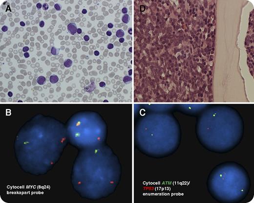 A 68-year-old woman presented with pneumonia and acute kidney injury. White blood cell count was 133.4 × 109/L (lymphocytes, 92.5 × 109/L). Blood count a month previously had shown mild lymphocytosis (9.6 × 109/L). Peripheral blood film showed 2 cell populations of small lymphocytes and 20% larger blast-like cells with small nucleoli (panel A; original magnification ×50, May-Grünwald-Giemsa stain) and morphology distinct from prolymphocytes, which typically have 1 large nucleolus. Peripheral blood immunophenotyping revealed 2 surface immunoglobulin κ restricted clonal B-cell populations, both positive for CD19/CD23/CD20/CD22/CD79b/CD38; the population with low forward scattered light was CD5+/FMC−; the other was CD5−/FMC7+. IGHV-D-J rearrangement analysis confirmed the 2 populations were clonally related. Peripheral blood and bone marrow fluorescence in situ hybridization detected abnormalities in 90% cells: smaller cells (70%) had standard MYC (8q24) rearrangement without ATM (11q22) or TP53 (17p13) abnormalities, whereas larger cells (∼20%) had both copies of MYC rearranged and additional ATM and TP53 loss (panels B-C), consistent with aggressive B-cell malignancy arising through clonal evolution of chronic lymphocytic leukemia (CLL) or Richter syndrome (RS). Bone marrow biopsy (panel D; original magnification ×20, hematoxylin and eosin stain) showed aggressive B-cell lymphoma involvement. / RS occurs in 2% to 10% of CLL cases: determining whether RS is clonally related (80% cases) to CLL is critical, as these cases carry poorer prognosis. Forty percent of RS cases develop before requiring CLL treatment and may have somewhat improved outcomes.