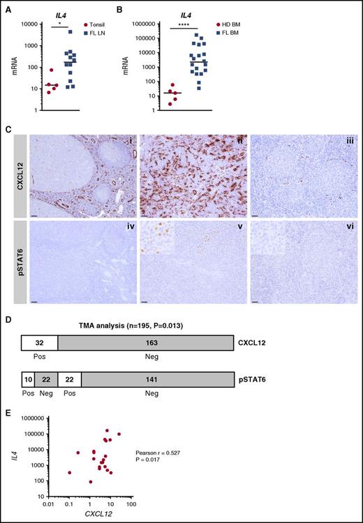 Figure 3. Expression and function of IL-4 within FL cell niches. (A) IL4 was quantified by RT-qPCR in frozen tonsil (n = 5) and FL-LN (n = 12) sections. (B) IL4 was quantified by RT-qPCR in whole BM cells from HDs (n = 5) and FL patients (n = 20). (C) (i-ii) Immunohistochemical staining for CXCL12 and pSTAT6 on reactive tonsil, (iii-iv) FL LN with high CXCL12/pSTAT6 expression, and (v-vi) FL LN with low CXCL12/pSTAT6 expression. Original magnification ×100 (i-ii: scale bars, 100 μm), ×200 (iii-vi: scale bars, 50 μm). (D) Semiquantitative assessment of CXCL12 and pSTAT6 on FL tissue biopsies arranged on tissue microarray (TMA). CXCL12 was scored positive when the expression was higher than in reactive GCs, and pSTAT6 was scored positive when frequent nuclear-positive cells within the malignant follicles were observed. (E) Correlation between IL4 and CXCL12 expression across the 20 FL BM samples. ****P < .0001; *P < .05.