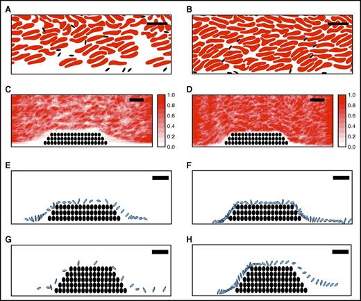 Figure 5. A computational model suggests elevated hematocrit increases the time that platelets spend in proximity to a thrombus. Simulations of whole blood flow with 40% (A, C, E, G) and 60% (B, D, F, H) hematocrit were conducted as described in “Methods.” (A-B) Snapshots showing instantaneous positions of RBCs (red) and platelets (black) for (A) 40% and (B) 60% hematocrit in flowing blood indicate RBCs are less prevalent close to vessel walls and platelets are more prevalent in this near-wall RBC-depleted zone. (C-D) Time-averaged RBC distribution for flow past a small thrombus (filled circles) in (C) 40% and (D) 60% hematocrit. The near-wall depleted zone is narrower in higher hematocrit. Scale indicates relative RBC distribution. (E-H) Time-dependent progression (2-millisecond intervals) of an individual platelet (blue) over a small or large thrombus (black circles): (E) 40% hematocrit, small thrombus, (F) 60% hematocrit, small thrombus, (G) 40% hematocrit, large thrombus, (H) 60% hematocrit, large thrombus. For both the small and the large thrombus, the platelet spends substantially more time near the thrombus for 60% hematocrit than for 40% hematocrit. Bars indicate 10 µm.