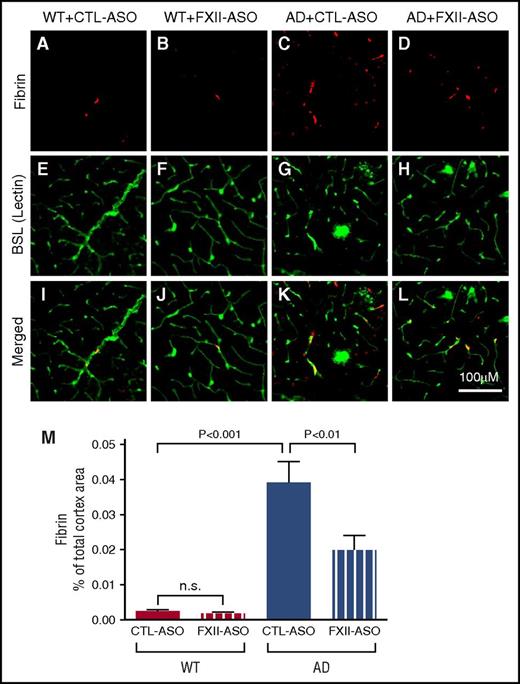 Figure 5. Fibrin(ogen) deposition is decreased in AD mice treated with FXII-ASO. Brain sections from WT and AD mice treated with CTL-ASO or FXII-ASO were stained with an antibody against fibrin(ogen) (A-D), blood vessels were visualized by lectin staining (E-H), and the images were merged (I-L). CTL-ASO–treated AD mice showed significantly more fibrin(ogen) staining (C) than CTL-ASO–treated WT mice (A). In FXII-ASO–treated AD mice, fibrin(ogen) deposition was significantly reduced (D,L,M) compared with CTL-ASO–treated AD mice (C,K,M). Fibrin(ogen) deposits were minimal in WT mice and were similar between CTL-ASO (A,I,M) and FXII-ASO treatments (B,J,M) (one-way ANOVA; n = 9-14 mice per group). All values presented as mean ± SEM. Results are from 3 independent experiments. Scale bar for panels A-L, 100 μm.