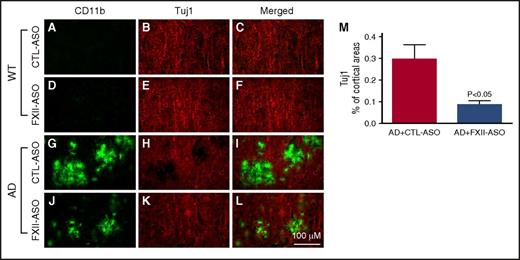 Figure 6. Depletion of plasma FXII reduces inflammation-associated neuronal damage in AD mouse brains. Brain sections from CTL-ASO- or FXII-ASO–treated WT and AD mice were stained with antibodies against CD11b (A,D,G,J) and Tuj1 (B,E,H,K), and the images were merged (C,F,I,L). In CTL-ASO–treated AD mice, the staining for Tuj1 was weaker in areas where CD11b staining was robust (G,H,I), indicating microglia/macrophage-associated neuronal damage. This microglia/macrophage-associated neuronal damage was significantly reduced in FXII-ASO–treated AD mice (J-M) compared with CTL-ASO–treated AD mice (G,H,I,M) There were no detectable microglia/macrophage-associated changes in Tuj1 staining in either CTL-ASO- or FXII-ASO–treated WT mice (A-F). Student t test, n = 10/group. All values presented as mean ± SEM. Results are from 3 independent experiments. Scale bar for panels A-L, 100 μm.