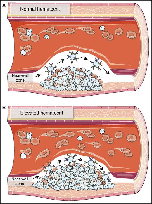 Schematic showing the mechanism of enhanced thrombosis in patients with elevated hematocrit. Increased RBCs narrow the near-wall RBC depleted zone around a growing thrombus. This narrowing traps platelets, allowing them to spend significantly more time in this zone, enhancing the probability that they will be incorporated into the clot. (A) Normal hematocrit and (B) elevated hematocrit. This figure was created with images adapted from Servier Medical Art by Servier. Original images are licensed under a Creative Commons Attribution 3.0 Unported License.