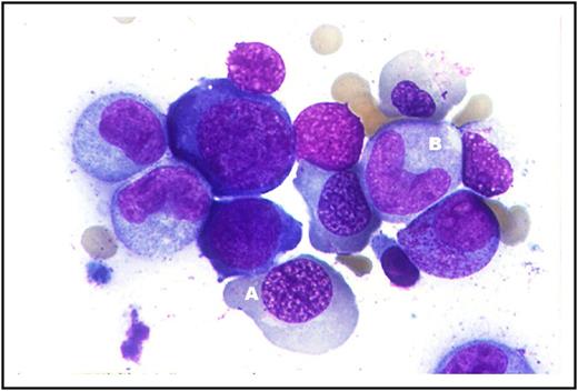 Figure 2. Photomicrograph of bone marrow in a patient with pernicious anemia. (A) Megaloblastic change in the nucleus of an erythroid precursors consisting of variegated finely granular chromatin (“salt-and-pepper” appearance) in contrast to the ground-glass texture of normal proerythroblasts. With progressive maturation, chromatin condensation occurs at a slower pace than normal, giving rise to darker aggregates that fuse nonhomogeneously and impart to the nucleus a characteristic latticelike appearance. Undisturbed maturation of the cytoplasm as hemoglobin forms in a cell with an immature-appearing nucleus results in cells that are conspicuous for their lack of synchrony between nuclear and cytoplasmic development. (B) A megaloblastic (“giant”) granulocyte precursor. Original magnification ×100; Wright-Giemsa stain.