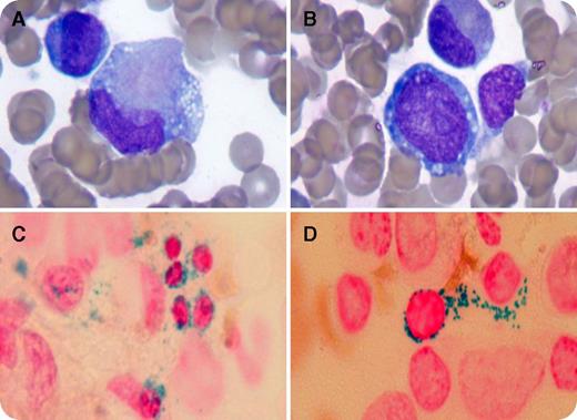 A 3-month-old boy presented with decreased appetite, fatigue, and a nosebleed. Initial workup revealed hemoglobin 2.6 g/dL (10.2-12.7), hematocrit 7.7% (30.9-37.9), mean corpuscular volume 104 fL (71.3-82.6), white blood cell count 4200/μL (240 absolute neutrophil count), platelets 50 000/μL (140-400), and reticulocyte count 1.31% (1.55-2.7). Bone marrow revealed hypercellularity with cytoplasmic vacuolization of myeloid and erythroid precursors (panels A-B; original magnification ×1000, Wright-Giemsa stain). Iron staining of marrow biopsy revealed numerous ringed sideroblasts (panels C-D; original magnification ×1000, Prussian blue stain). DNA was examined by array-based comparative genomic hybridization and revealed a 4.9-kb deletion, m.11027_15950del4923, consistent with mitochondrial DNA deletion syndrome, also known as Pearson syndrome. Fecal elastase was initially normal, but now it is <15 μg/g (normal >200), consistent with severe pancreatic insufficiency. We have begun pancreatic enzyme replacement. / Pearson marrow pancreas syndrome (PMPS) is an exceedingly rare mitochondrial disorder. Therefore, prevalence of PMPS is unknown. Affected children typically present in infancy with a hematologic disturbance consistent with an inherited bone marrow failure syndrome and congenital sideroblastic anemia. Important clues to the diagnosis include cytoplasmic vacuolization of erythroid and myeloid precursors along with ringed sideroblasts on bone marrow evaluation. Another hallmark clinical feature is exocrine pancreatic insufficiency. Currently, there is no cure for this condition. The most common causes of death include overwhelming infection, lactic acidosis, and multiorgan failure.