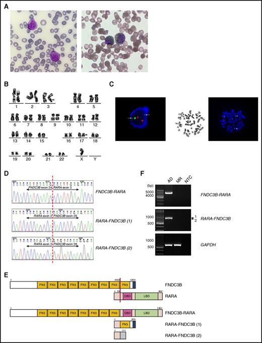 Figure 1. Identification of FNDC3B as a new fusion partner of RARA in a variant APL. (A) Left, May-Grünwald-Giemsa staining showing 2 abnormal promyelocytes in the diagnostic BM aspirate. The abnormal cells in the BM were medium-sized and showed round, indented, or occasionally bilobed nuclei, dispersed chromatin, prominent nucleoli, and abundant heavily granulated cytoplasm. Auer rod was rarely found. Right, Sudan Black B (SBB) staining on BM aspirate showing 2 SBB-positive abnormal promyelocytes. Original magnification ×1000. (B) A karyotype performed on the diagnostic BM revealed 45,X,-Y,t(3;17)(q26;q21). The breakpoint regions of derivative chromosomes 3 and 17 are marked with arrows. (C) Left, Interphase FISH using the PML/RARA dual-color dual-fusion translocation probes revealed splitting of the RARA gene. Two diminished split RARA signals (green) are marked with arrows. Right, Metaphase FISH analysis confirmed 3′-RARA location at 3q26 (arrowhead). 5′-RARA remained at the long arm of derivative chromosome 17 (arrow). (D) Partial nucleotide sequences surrounding the junctions of the FNDC3B-RARA and RARA-FNDC3B fusions. RARA-FNDC3B (1) and RARA-FNDC3B (2) represent the major and minor reciprocal fusion transcripts, respectively. (E) Schematic diagram of FNDC3B, RARA, FNDC3B-RARA, and RARA-FNDC3B fusion proteins. The breakpoint is indicated by a red line. The blue area in FNDC3B is a putative transmembrane domain. The shaded area in RARA-FNDC3B (2) indicates novel sequences resulting from an out-of-frame fusion. The numbers indicate amino acid positions. (F) RT-PCR analysis of the full-length FNDC3B-RARA and RARA-FNDC3B fusion transcripts in BM collected at diagnosis (AD) and molecular remission (MR). Amplification of GAPDH served as an internal control. DBD, DNA-binding domain; LBD, ligand-binding domain; NTC, no template control.