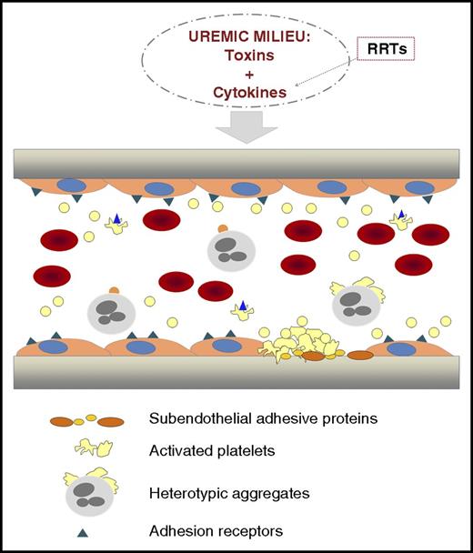 Illustration representing a longitudinal section of a vascular vessel. In CKD, toxins and cytokines are present in the circulation. RRTs, although necessary, contribute to activate circulating blood cells with the release of cytokines that enrich the toxic environment. Chronic inflammation and oxidative stress coexist with endothelial dysfunction in CKD. The hematocrit is decreased because of the anemia. Activated platelets circulate and form heterotypic aggregates with monocytes. Platelet hyperactivity contributes to thrombus formation. From Yang et al, the uremic toxin indoxyl sulfate seems to play a crucial role in the activation of these processes, and Klotho protein could be a promising strategy to prevent them.