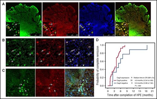 Figure 2. Double immunolabeling of CagA expression in tumor cells of gastric “pure” DLBCL and time to CR of patients with HP-dependent gastric DLBCL. (A) Double immunolabeling of CagA and CD20 in an HP-dependent gastric “pure” DLBCL case with immunohistochemically identified CagA expression. Confocal microscopy showing that most CagA-positive cells (green fluorescence) expressed CD20 (red fluorescence). Image of nucleus (DAPI), or a merged image of CagA and CD20 expression. Left bottom inset, The white arrow represents CagA expression (nuclear or cytoplasmic expression), CD20 expression (cytoplasmic expression), nucleus (DAPI), or the merged images of CagA and CD20 expression; the yellow arrow represents no CagA expression, positive CD20 expression (cytoplasmic expression), nucleus (DAPI), or the merged images of CD20 expression alone. (B) The majority of the tumor cells (red fluorescence, CD20) contain cytoplasmic CagA (green fluorescence). The white arrow represents CagA expression, CD20 expression, nucleus (DAPI), or the merged images of CagA and CD20 expression (the confocal image was viewed at ×630). (C) The majority of the tumor cells (red fluorescence, CD20) contain nuclear or cytoplasmic CagA (green fluorescence). The white arrow represents CagA expression, CD20 expression, nucleus (DAPI), or the merged images of CagA and CD20 expression (the confocal image was viewed at ×630). (D) Time to CR was calculated from the completion of antibiotic treatment to the first evidence of CR through Kaplan-Meier analysis (CagA-positive group vs CagA-negative group, 2-sided log-rank test; P = .05).