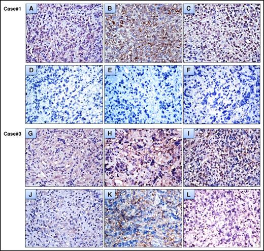 Figure 3. Changes in the expression levels of CagA and Cag-signaling molecules in serial tumor cells before and after completion of HPE (A) A high baseline expression of CagA in case #1 tumor cells. (B) A high baseline expression of p-SHP-2 in case #1 tumor cells. (C) A high baseline expression of p-ERK in case #1 tumor cells. (D) CagA expression was no longer detectable in remitting tumor cells 1 month after completion of HPE (case #1, the time to CR after completion of HPE was 4 month). Immunohistochemical staining showed no expression of p-SHP-2 (E) and p-ERK (F) in remitting tumor cells 1 month after completion of HPE (case #1). (G) High baseline expression of CagA in case #3 tumor cells. (H) A high baseline expression of p-SHP-2 in case #3 tumor cells. (I) A high baseline expression of p-ERK in case #3 tumor cells. (J) Decreased expression of CagA in tumor cells that achieved partial remission 4 months after completion of HPE (case #3, the time to CR after completion of HPE was 10 months). Immunohistochemical staining showed decreased expression of p-SHP-2 (K) and p-ERK (L) in tumor cells that achieved partial remission 4 months after completion of HPE (case #3). All immunohistochemical images were viewed at ×400.