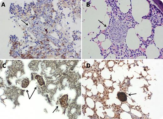 A 70-year-old woman, with a history of diffuse large B-cell lymphoma treated with rituximab–cyclophosphamide, doxorubicin, vincristine, and prednisone during 2014, presented in June 2016 with pancytopenia (white blood cell count, 0.6 × 109/L; hemoglobin, 9.7 g/dL; platelets, 43 × 109/L) and lung nodule. Lung biopsy revealed poorly differentiated squamous cell carcinoma. On flow cytometry of bone marrow (BM) aspiration, 28% of cells were blasts, positive for CD123, CD13, CD33, CD117, CD34, and HLA-DR. BM biopsy revealed 20% to 30% blasts which were positive, by immunohistochemistry, to CD34 and c-kit (panel A; CD34 stain, original magnification ×20) and, in addition, there were nerves (panel A; panel B; hematoxylin and eosin stain, original magnification ×20). The nerves’ structure was more prominent by reticulin stain (panel C; original magnification ×10) and was confirmed by S-100 stain (panel D; original magnification ×10). It should be noted that BM biopsies that were done in 2014 as part of lymphoma evaluation did not show ectopic nerve tissue. / These ectopic nerves are not supposed to appear in the BM. Normal BM contains, in addition to hematopoietic and stromal cells, mesenchymal stem cells which might be induced, in the laboratory, to be neural stem cells. Nevertheless, the appearance of ectopic nerves in the BM is a unique phenomenon with unknown etiology and significance.