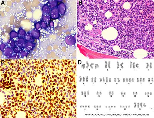 A 61-year-old woman presented with pancytopenia, hemoglobin 100 g/L, neutrophils 0.77 × 109/L, and platelets 50 × 109/L. Blood film showed a leukoerythroblastic picture with cytoplasmic vacuolated blasts. Marrow aspirate was dry tap, but touch preparations of the biopsy demonstrated sheets of blasts with Burkitt-like morphology including basophilic cytoplasm, variable numbers of nucleoli, and cytoplasmic vacuolations (panel A; original magnification ×100; oil immersion). Flow immunophenotyping of the peripheral blood showed 13% blasts, which were CD19+/CD10+/Tdt+/CD22+/HLA−DR+/partial CD20+, but were negative for CD45−/CD34−. Biopsy was hypercellular with blasts having irregular nuclear-contour (panel B; original magnification ×40; hematoxylin and eosin stain). Immunohistochemistry illustrated the blasts were CD19+/CD10+/partial CD20+/CD79+/PAX5+/BCL6+/Tdt+/Ki-67+ (>90%)/P53+/C-MYC+ (60% to 70%; panel C; original magnification ×40; C-MYC stain). These findings were consistent with B acute lymphoblastic leukemia (B-ALL). Chromosome analysis showed near-triploidy with 66 chromosomes (panel D), confirmed by fluorescence in situ hybridization studies to be present in 14% of cells. The patient was treated with a hyper–cyclophosphamide, vincristine, doxorubicin, and dexamethasone regimen but died with relapse 11 months after initial diagnosis. / Near-triploidy is a rare chromosomal abnormality in adult B-ALL with a 93% TP53 mutation rate, thought to arise from doubling of a masked hypodiploid clone. It has been suggested that near-triploidy, with or without a hypodipoid clone, should be included in the B-ALL with hypodiploidy with poor prognosis and should not be confused with B-ALL with hyperdiploidy (>50 and usually <66 chromosomes) with favorable prognosis.