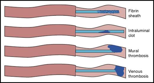 Figure 1. Type of CVAD-related thrombotic occlusions. Adapted from Baskin et al.1