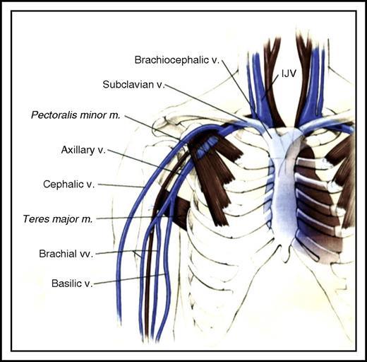 Figure 2. Schematic drawing of the venous anatomy of the upper extremity. IJV, internal jugular vein; m, muscle; v., vein; vv., veins. Adapted from Rumack et al.74
