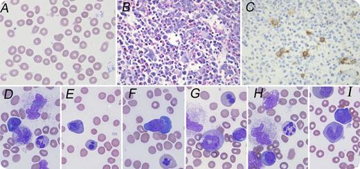 An 11-month-old girl presented with fatigue and vomiting. Complete blood count revealed severe macrocytic anemia (hemoglobin, 2.8 g/dL; mean corpuscular volume, 117 fL), thrombocytopenia (platelets, 117 × 109/L), and normal white blood cell count (13.6 × 109/L). Peripheral blood smear revealed anisocytic erythrocytes with frequent macroovalocytes (panel A; original magnification ×1000, Wright's stain). Serum cobalamin and erythrocyte folate were within normal limits. Bone marrow (BM) biopsy showed hypercellular marrow with frequent megaloblasts and few micromegakaryocytes (panel B; original magnification ×400, hematoxylin and eosin stain), which were easily seen on CD61 immunostain (panel C; original magnification ×400). BM smears showed >50% of the erythroblasts with dysplastic features, including nuclear-cytoplasmic asynchrony, nuclear lobation or irregular shapes, and frequent giant bands or neutrophils with abnormal nuclear lobation (panels D-I; original magnification ×1000, Wright-Giemsa stain). Cytogenetic study revealed normal female karyotype. Exome next-generation sequencing revealed 2 variants of the TCN2 gene (22q12.2), a 2-base deletion, and a nonsense mutation, consistent with transcobalamin II (TCII) deficiency. / TCII deficiency is a rare autosomal-recessive disease characterized by defective intestinal absorption of cobalamin and decreased cobalamin availability. The early recognition of this condition is critical because early parenteral cobalamin therapy can result in complete resolution of symptoms and normal growth; neurologic damage may become permanent if initiation of treatment is delayed. TCII deficiency should be considered in infants with megaloblastic anemia and/or hematopoietic dyspoiesis with normal cobalamin/folate levels.