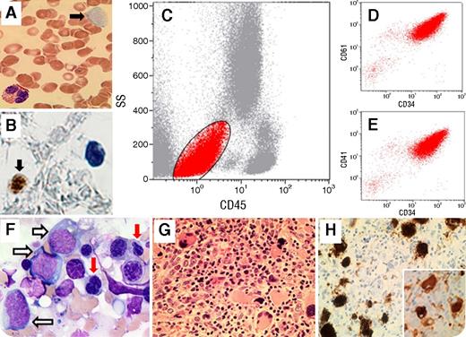 A 65-year-old woman presented with fatigue and exertional dyspnea. The peripheral blood showed: hemoglobin, 91 g/L; leukocytes, 4.8 × 109/L with 1% blast cells; and platelets, 35 × 109/L with megakaryocytic fragments (panel A, filled black arrow; original magnification ×100; May-Grünwald-Giemsa stain). By flow cytometry on the peripheral blood specimen, there was a population of CD45− and low side scatter (18%) that was positive for CD34, CD41, and CD61 (panels C-E, red), and negative for all myeloid- and lymphoid-associated markers. Those were CD34+ megakaryocytic fragments confirmed by immunohistochemistry (panel B, filled black arrow; original magnification ×100; CD34 stain). The bone marrow aspiration and biopsy revealed hypercellularity with 12% blasts (panel F, unfilled arrows; original magnification ×100; May-Grünwald-Giemsa stain), dyserythropoiesis (red arrows), and megakaryocytic hyperplasia and dysplasia (panel G; original magnification ×40; hematoxylin and eosin stain). Immunohistochemistry showed coexpression of CD61 (panel H; original magnification ×40; CD61 stain) and CD34 (panel H, inset; original magnification ×40; CD34 stain) on megakaryocytes. Cytogenetics showed normal karyotype. The diagnosis of myelodysplastic syndrome (MDS) with excess blasts-2 was rendered. / CD34 can be expressed in a subset of megakaryocytes in patients with MDS. Megakaryocytic fragments are larger platelet-like fragments which detach earlier and closer to the megakaryocytic core as a rapid response to thrombocytopenia, then cross the sinusoidal barrier and enter the blood. Our case also highlights the importance of reviewing peripheral blood smear in MDS patients, and performing accurate morphological and immunophenotypic analysis in the presence of a cell population positive for CD34.