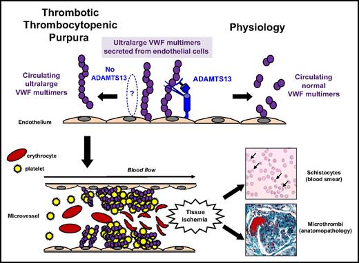 Figure 2. Pathophysiology for TTP. In physiologic conditions, ultralarge VWF multimers released from endothelial cells are cleaved by ADAMTS13 in smaller VWF multimers, less adhesive to platelets. In TTP, because of the absence of functional ADAMTS13 (either absent by congenital defect or inhibited by specific autoantibodies), ultralarge VWF multimers are released into the blood and bind spontaneously to platelets to form aggregates within the arterial and capillary microvessels. The VWF–platelet aggregates are large enough to form microthrombi inducing tissue ischemia, platelet consumption, and microangiopathic hemolytic anemia (schistocytes on blood smear).