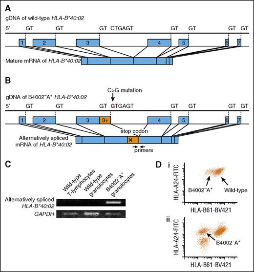 Figure 3. A mutation creating an alternative splice site in case 6. (A) Normal splicing of HLA-B*40:02. (B) The C>G mutation in intron 3 created an alternative 5′ splicing site with a strong consensus sequence, GTGAGT, which can change the splicing of HLA-B*40:02, leading to a stop codon formation. (C) mRNA from 3 different leukocyte subsets was reverse-transcribed and amplified with alternatively spliced mRNA-specific primers. Glyceraldehyde-3-phosphate dehydrogenase (GAPDH) mRNA was amplified as an internal control. (D) The expression level of HLA-B4002 by B4002−A+ granulocytes of case 6 (i) was higher than that by B4002−A+ granulocytes of case 12 (ii), which lost HLA-B4002 because of nonsense and frameshift mutations. gDNA, genomic DNA.