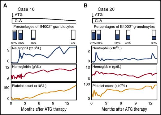 Figure 4. Chronological analysis of B4002− granulocytes. The percentages of B4002− granulocytes in case 16 (A) and case 20 (B) were determined several times after ATG/CsA therapy. Both patients responded to the therapy, and their hematological recovery was associated with a decrease in the B4002− granulocyte percentage.