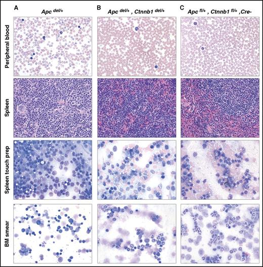 Figure 2. Decreasing Ctnnb1 levels in Apcdel/+ mice reverses the MDS phenotype. Histology of hematopoietic tissues from a representative Apcdel/+ mouse (A, mouse 3938) euthanized when displaying severe signs of anemia (241 days) vs an Apcdel/+, Ctnnb1del/+ mouse (B, mouse 8455), and an Apcfl/+, Ctnnb1fl/+, Cre− mouse (C, mouse 8740) euthanized at the end of the study (∼400 days). All images were obtained using an Olympus BX41 microscope (Melville, NY) and a 50×/0.9 (oil) or 40×/0.9 objective. Images were processed with Adobe Photoshop (San Jose, CA). Peripheral blood smears, BM smears, and spleen touch preparations were stained with Wright-Giemsa (original magnification ×500), and spleen sections were stained with hematoxylin and eosin (H&E; original magnification ×400).