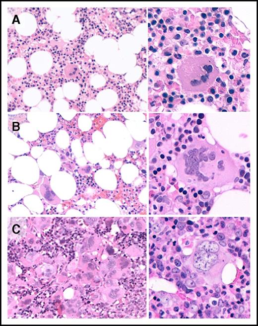 Figure 1. Representative histological features of pediatric cases with (A) ST, (B) ET, and (C) pre-PMF. (A) Normocellular BM with scattered nondescript MK. (B) Loose clusters of MKs with hypersegmented (staghorn-like) nuclei. (C) Tight clusters of atypical MKs with bulbous (cloud-like) nuclei. Hematoxylin and eosin stain, original magnification ×10 and ×20; Leica DM4000 B optic microscope, DFC420 camera and acquisition software (Leica Microsystems, Milan, Italy).