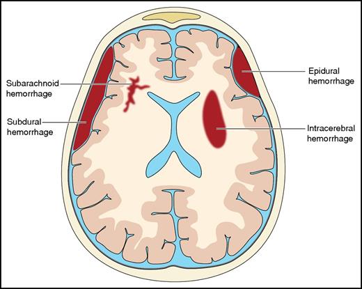 Intracranial hemorrhage can occur in all compartments within the skull. Intracerebral hematomas occur either spontaneously or traumatically within the brain tissue, whereas subdural and epidural hematomas are often associated with traumatic head injury. Epidural hemorrhage rarely occurs in elderly patients because the dura mater adheres to the bone with increasing age, preventing the formation of hematomas in this compartment. Professional illustration by Patrick Lane, ScEYEnce Studios.