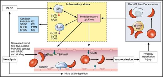 Role of mononuclear cells in the pathophysiology of SCD. Vaso-occlusion and tissue injury lead to activation of the mononuclear cells and the release of proinflammatory cytokines. This leads to further adhesion of sickle red cells and leukocytes to the vascular endothelium perpetuating the vicious cycle of vaso-occlusion and inflammation. CAM, cell adhesion molecule; EC, endothelial cell; MN, monocyte; PLGF, placental growth factor; PMN, polymorphonuclear leukocyte; SRBC, sickle red blood cell; TSP/vWF, thrombospondin/von Willebrand factor. Professional illustration by Patrick Lane, ScEYEnce Studios.