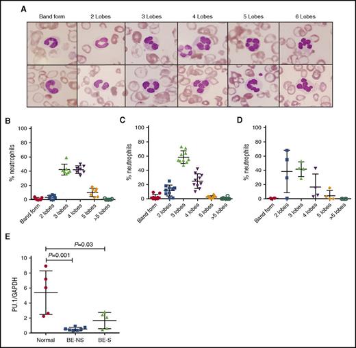 Figure 7. Analysis of neutrophils from nonsplenectomized and splenectomized HbE/β-thalassemia subjects. (A) Representative morphological analysis of human neutrophils in the peripheral blood of HbE/β-thalassemia subjects. Analysis of neutrophil nuclei lobe numbers in (B) healthy (control) individuals, (C) nonsplenectomized HbE/β-thalassemia patients, and (D) splenectomized HbE/β-thalassemia patients. One hundred neutrophils from each individual were counted and classified into neutrophil subsets based on nuclear lobe numbers. (E) RT-qPCR analysis of PU.1 mRNA expression levels relative to housekeeping gene GAPDH in neutrophils isolated from the peripheral blood of healthy control individuals, nonsplenectomized (NS), and splenectomized (S) HbE/β-thalassemia (BE) patients. The statistical significance between the groups was evaluated with Student t test. Cells were visualized following Wright Giemsa staining (original magnification ×400).