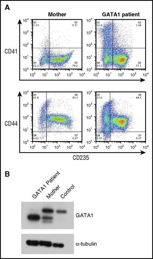 Figure 4. Analysis of erythroid cells from patients with a mutation in GATA1. (A) Flow cytometric analysis of CD34+ cells from the carrier mother and a DBA patient with a GATA1 mutation cultured for 14 days. The cells were labeled with CD235, CD44, and CD41 antibodies. (B) Lysates from differentiating erythroid cells from a patient with a GATA1 mutation, the carrier mother, and a control donor were immunoblotted with antibodies against GATA1 and α-tubulin (loading control).