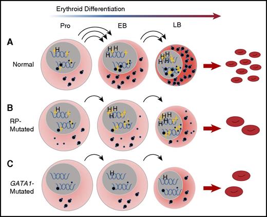 Figure 7. A convergent model for the effect of RP and GATA1 mutations on erythroid differentiation in DBA. (A) Under conditions of normal hematopoiesis, rising GATA1L levels (gold stars, nuclear) in CD41−/CD44+/CD235− cells promote the erythroid program by stimulating the expression of canonical GATA1 targets, such as heme synthesis genes, as well as enhancing expression of components of the translational apparatus, including ribosomal RNA, snoRNA, and ribosomal proteins. The net effect of these activities is the accumulation of sufficient translational competence (cytoplasmic, illustrated as mature 80S ribosomes) to support normal differentiation and proliferation from proerythroblasts into early and late basophilic erythroblasts. (B) In RP-mutated erythropoiesis, GATA1L is present to promote heme synthesis as well as upregulation of the translational apparatus; however, abortive ribosomal assembly (illustrated as a large-subunit defect with accumulation of free cytoplasmic 40S ribosomes) limits accretion of translational competence, with reduced proliferation of erythroid progenitors, delays in the maturational program, and anemia. (C) In GATA1-mediated DBA, the absence of GATA1L limits upregulation of the translational apparatus without abortive ribosome assembly, but with similar consequences to proliferation and differentiation of erythroid progenitors. This model places GATA1 as a master regulator in DBA that operates upstream from RP gene alterations. EB, early basophilic erythroblasts; H, heme synthesis genes; LB, late basophilic erythroblasts; Pro, proerythroblasts.