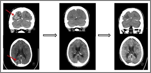 Figure 1. Pre- and posttreatment head CTs with contrast in a patient with primary refractory PCNSL. (Left) The contrast-enhancing lesion before treatment with nivolumab. (Middle) Complete response following 2 months therapy with nivolumab. (Right) Continued complete response 13 months following initiation of therapy.