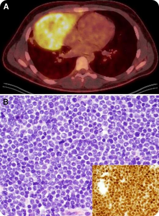 An 18-year-old man presented with a 2-month history of unintentional 23-kg weight loss, night sweats, and left-sided neck swelling. Physical examination revealed left supraclavicular lymphadenopathy. A complete blood count was within normal limits (white blood cells, 6.6 × 109/L) and a peripheral blood smear only identified a rare immature cell. Positron emission tomography showed a 16- × 9-cm hypermetabolic mediastinal mass mirroring the heart in the right hemithorax (panel A, “double-heart” sign) and extending into the neck. Biopsy of the mediastinal mass revealed a diffuse infiltrate of intermediate-sized T lymphoblasts with high nuclear-to-cytoplasmic ratio, fine chromatin, prominent nucleoli, and frequent mitotic figures (panel B; original magnification ×400; main panel, hematoxylin and eosin stain; inset, terminal deoxynucleotidyl transferase stain). The bone marrow was 50% involved, establishing a diagnosis of T-cell acute lymphoblastic leukemia (T-ALL). Cervical lymphadenopathy resolved completely on physical examination within 2 days of starting steroids as a component of AALL1231 and the patient achieved a complete remission after 1 cycle. / The differential diagnosis of a mediastinal mass in a young adult includes thymoma, T-ALL, large B-cell lymphoma, Hodgkin lymphoma, and germ cell tumors. T-ALL masses are often exquisitely sensitive to steroids; hence, empiric steroid treatment before biopsy may result in rapid resolution of the mass and inadequate or nondiagnostic biopsy specimens.