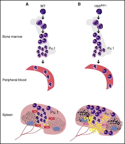 Neutrophil dysfunction in β-thalassemia. In WT mice (A), neutrophils mature normally and are released into peripheral blood. Similarly, in the spleen, the majority of neutrophils are mature, and efficiently phagocytose and kill bacteria (yellow dots), along with production and release of abundant ROS. Macrophages intricately interact with neutrophils to resolve the infection. In older mice with β-thalassemia (B) that have developed iron overload, BM neutrophils are normal, but in peripheral blood and spleen, immature neutrophils accumulate. In the spleen, these immature neutrophils have decreased Pu.1 expression, fail to upregulate Pu.1 upon activation by bacterial infection, and produce deficient levels of ROS. They fail to phagocytose bacteria, and mice succumb to infection. Meanwhile, macrophages in the spleen are iron loaded (indicated by black dots) and may compound the deficiencies in the innate immune system observed in patients with β-thalassemia.9